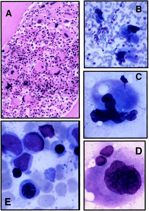 Fig. 3. Bone marrow evaluation of a thrombocytopenic member. / Bone marrow aspirate and biopsy specimen were obtained from II-4 as part of his normal medical care. (A) Biopsy specimen; original magnification, 100 ×. (B-D) Typical megakaryocytes identified from bone marrow aspirate; original magnifications, 200 × (B), 500 × (C), 1000 × (D). (E) Erythroid precursors in bone marrow aspirate; original magnification, 1000 ×.
