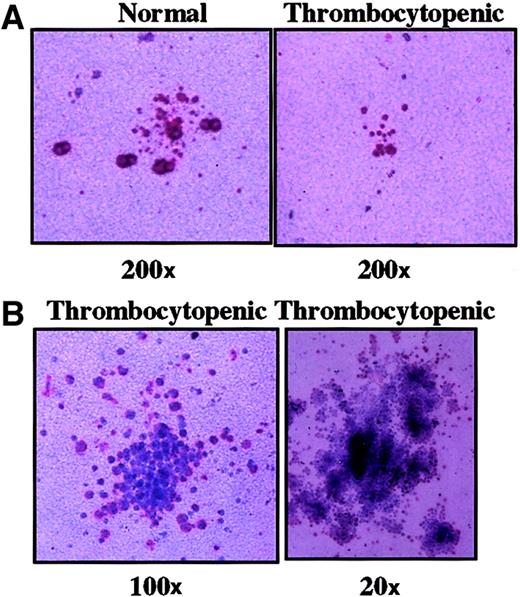 Fig. 5. Megakaryocyte colonies from peripheral blood progenitors. / After 14 days of incubation, megakaryocyte colonies were visualized by immunostaining to detect GPIIb/IIIa-expressing cells (pink-red). (A) (right) Typical small (3-20 cells) CFU-Mks from an asymptomatic carrier (original magnification, 200 ×; II-7). (left) Cluster of small GPIIb/IIIa cells seen in cultures of thrombocytopenic control subjects (II-5). (B) Representative atypical colonies seen in thrombocytopenic members. Cells are large but weakly positive for GPIIb/IIIa (original magnification as indicated; II-4 and II-5).
