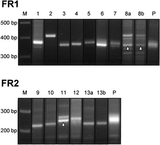 Fig. 1. Detection of clonal VDJ rearrangements in PMBL. / DNA from PMBL tissue was submitted to a PCR with primer combination FR1. Cases that did not reveal clonal signals with FR1 were reanalyzed with an alternative primer set FR2. Monoclonal rearrangements are identified by a sharp, distinct band in comparison with diffuse signals generated from polyclonal control samples (P). In cases 8a, 8b, and 11, specific PCR products are indicated by an arrowhead. Additional bands detectable in these cases proved to be nonspecific upon sequence analysis. M indicates molecular size marker.