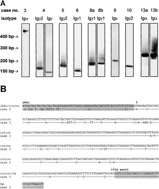 Fig. 4. Detection of VH-CH transcripts of the IgH gene. / VH-CH transcripts were amplified by RT-PCR with lymphoma-specific 5′ primers and isotype-specific 3′ primers, transferred to nylon membranes, and labeled by isotype-specific probes (A). The identity of the PCR products was confirmed by cloning and sequencing. In case 3, an abnormally large Igα transcript was observed. Sequence analysis of this transcript (B) revealed an aberrant VH-Cα splicing, caused by a T>G transversion within the regular donor splice site at the 3′ end of VHDHJH6 (single arrow) and use of a cryptic donor splice sequence (double arrows mark the first 2 bases of cryptic donor site). As a result, VHDHJH6 and Cα exon 1 (both indicated by gray background) are separated by a 373-bp intronic sequence. Note the high rate of somatic hypermutation carried far into the intron. This sequence has been submitted to the EMBL/GenBank/DDBJ database under accession number AJ292071.
