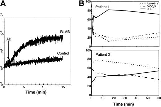 Fig. 6. Kinetics of R-CDC–induced ROS production, loss of Δψm, and phosphatidylserine exposure. / (A) The kinetics of ROS generation were analyzed in cells from a patient with MCL with CD20++ expression (119 × 103 CD20 molecules/cell) as described in “Patients, materials, and methods.” (B) Time-course of ROS production (solid line), loss of ΔΨm (dashed line), and annexin V exposure (dotted line) in cells from a patient with MCL with very high levels of CD20 (137 × 103 molecules/cell) (top panel) and a CD20++ patient with B-CLL with high levels of CD20 (70 × 103 molecules/cell) (lower panel).