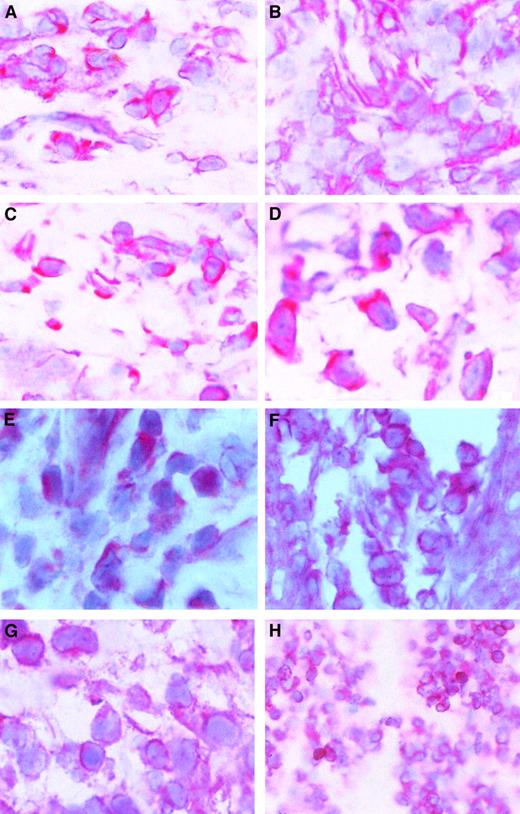 Fig. 5. c-Myb protein expression and localization in skin lesions. / Immunohistochemical stainings of skin lesions of an early (A) and a late (B) stage of mycosis fungoides and an early (C) and a late (D) stage of Sézary syndrome. Hematoxylin-eosin–stained slices from cryo-conserved biopsy material were tested with a c-Myb–specific antibody. Magnifications are 62.5 × (A-C) and 100 × (D). STAT2 (E), STAT5 (F), STAT6 (G), and bcl-2 (H) expression and localization in CTCL skin lesions. Hematoxylin-eosin–stained slices from cryoconserved biopsy material were tested with a STAT5-specific antibody. Magnifications are 100 × (E, G), 62.5 × (F), and 25 × (H).