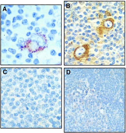 Fig. 2. Immunohistochemical staining of RANK protein in primary lymphoid tumors. / RANK was highly expressed in H/RS cells of a lymph node involved with nodular sclerosis (A) and mixed cellularity (B). The surrounding infiltrating cells rarely, but weakly, expressed RANK. Section from a lymph node involved with B-cell lymphocytic lymphoma (C) and from a benign hyperplastic lymph node (D) showing that RANK was rarely, but weakly expressed in these sections.