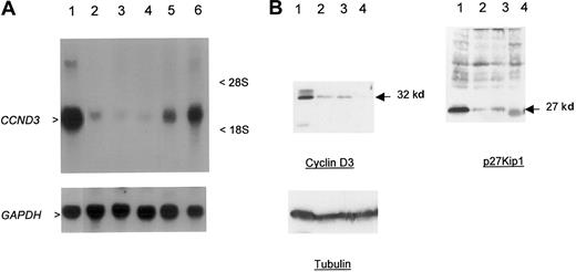 Fig. 2. Overexpression of cyclin D3 in a case of CD5+ DLBCL. / (A) Northern blot; 30 μg total RNA was used per lane. Upper panel probe CCND3 mRNA, lower panel GAPDH as loading control. RNA from patient 1 (lane 1) showed overexpression ofCCND3 in comparison to DLBCL cell line MD903 with t(3;14)(q27;q32) (lane 2), DLBCL cell line CTB-1 with t(3;14)(q27;q32) (lane 3), mantle-cell NHL cell line Granta 519 with t(11;14)(q13;q32) (lane 4), transformed SLVL cell line Karpas 1718 (lane 5), and B-ALL (FAB L3) cell line KHM-10B with t(8;22)(q24;q11) (lane 6). Arrowheads indicate 2.0-kb CCND3 transcript. (B) Western blot analysis of CCND3 protein. Total cell extracts (30 μg) from patient 1 were subjected to Western blot and probed with Mabs to cyclin D3, p27Kip1, and tubulin (lower panel) as a loading control. Lane 1, patient material; lane 2, HUT78 T-NHL cell line; lane 3, CEMO cell line; and lane 4, RPMI8226. Arrow indicates 32-kd cyclin D3 and 27-kd p27Kip1 proteins.