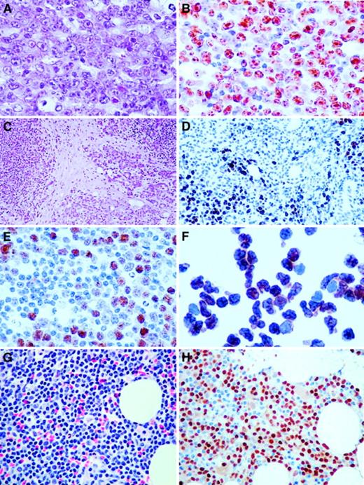 Fig. 3. Immunohistochemistry of cases with t(6;14)(p21.1;q32.3). / (A) Hematoxylin and eosin (H&E) section of a lymph node biopsy of the index case (Table 1, case 1), showing a diffuse infiltrate of large neoplastic B cells including centroblasts and some immunoblasts (original magnification × 400). (B) Same section as A stained with antibody to cyclin D3, showing the majority of the tumor cells with strong nuclear positivity (original magnification × 400). (C) H&E section of case 5 (original magnification × 100), showing background parotid gland and extranodal marginal zone B-cell lymphoma of MALT type. (D) Cyclin D3 staining of a focal area of large B-cell transformation in a background of parotid gland and low-grade extranodal marginal zone B-cell lymphoma of MALT type. Note salivary gland duct epithelium without cyclin D3 staining (original magnification × 200). (E) Same section as D stained with antibody to cyclin D3, showing focus of large neoplastic B cells with nuclear staining (original magnification × 300). (F) Cytospin of cells in the peripheral blood of case 3 stained with antibody to cyclin D3, showing intense nuclear staining of virtually all cells (original magnification × 400). (G) H&E section of bone marrow biopsy (Table 1, case 3), showing infiltrate of small B cells (original magnification × 400). (H) Same section of bone marrow stained with antibody to cyclin D3, showing intense nuclear staining of the small neoplastic B cells (original magnification × 400).