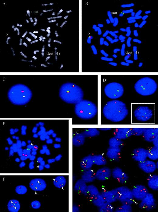 Fig. 4. FISH assays for the detection of t(6;14)(p21.1;q32.3). / (A-B) R-banding and FISH analysis of patient 5, Table 1. FISH was performed with chromosome 6p21 probes hybridizing immediately centromeric (green) and telomeric (red) of the CCND3 gene. Signals were observed on the intact chromosome 6 (colocalization of red and green signals) and on the der(14)t(6;14)(p21.1;q32.3) containing the telomeric 6p21 signal (red). The green signal (centromeric 6p21) was on a marker chromosome whose constitution could not be determined by morphology. (C-D, large picture) FISH with probes flanking the CCND3 locus in cases 2 and 4. An intact CCND3 locus is indicated by a colocalized red/green signal. The split indicates the break event. (D, small figure) FISH in case 6 shows a complexly aberrant nucleus with 2 intact CCND3 loci (fused signals) as well as a split of the signals, indicating the breakpoint in the CCND3locus. (E-G) FISH with probes spanning the IGH andCCND3 loci in cases 1 and 3, Table 1. As both IGH(green) and CCND3 (red) probe pools span the recurrent breakpoint regions 2 fusion signals (arrowheads) are to be expected, indicating the der(6)t(6;14)(p21.1;q32.3) and der(14)t(6;14)(p21.1;q32.3) in addition to each isolated signal indicating the intact IGH and CCND3 loci. This expected pattern is clearly seen in the aberrant metaphase (E) and the tumor cell nuclei (F) of case 3. In case 1 (G) the pattern is more complex, but fusion of IGH and CCND3 can be seen in most of the cells (arrowheads). On the basis of FISH analyses with differentially labeled probes flanking the CCND3 andIGH loci, respectively, the lack of one fusion signal and the supernumerary CCND3 signals detectable in many cells in this case is most likely due to a gain of one intact copy of the CCND3 locus and loss of the der(6)t(6;14)(p21.1;q32.3) (data not shown).