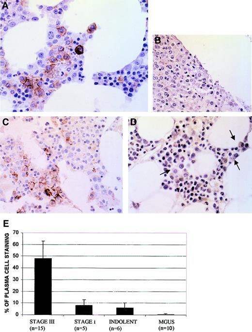 Fig. 1. Immunohistochemistry of BM stained with phosphospecific anti-AKT antibody. / (A) Myeloma marrow with immunostained plasma cells in a membrane-specific pattern. (B) Myeloma marrow stained with antibody after antibody was first preabsorbed with phosphorylated AKT peptide. (C) Myeloma marrow (same as used in panel B) stained with the same antibody after antibody was preabsorbed with nonphosphorylated AKT peptide. (D) MGUS marrow stained with phosphospecific AKT antibody. Three plasma cells are shown with arrows; original magnification × 400. (E) Frequency (mean ± SD) of plasma cells immunostaining in patient marrows.