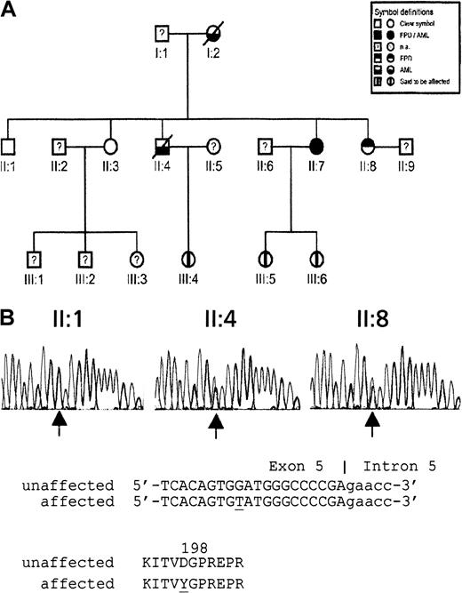 Fig. 1. Pedigree of 3-generation family with FPD/AML and sequence analysis of D198Y missense mutation. / (A) Pedigree (na, not analyzed). (B) Detection by sequence analysis of a mutation in exon 5 of CBFA2 using second-generation family members II:1 (nonaffected), II:4 (affected), and II:7 (affected). Arrows indicate the position of the mutation. Genomic and encoded amino acid sequences are depicted. Affected nucleotide and amino acid are underlined.