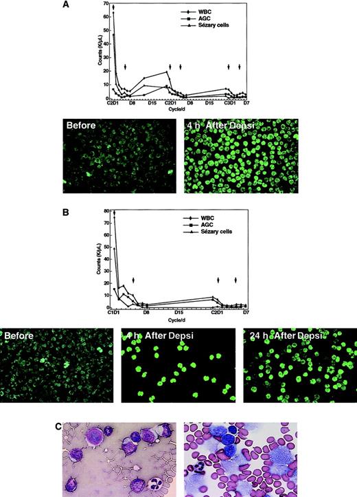 Fig. 1. Effect of treatment on Sézary cell count, histone acetylation, and lymphoma cells. / The graphs represent the WBC, absolute granulocyte count, and Sézary cell counts of patient 1 (panel A) and 2 (panel B) in response to treatment with depsipeptide. The x-axis indicates the days of the cycle; the arrows in the chart indicate the days that depsipeptide was administered. Below are peripheral mononuclear cells following fluorescent labeling with anti–acetyl histone H3. The majority of the cells are Sézary cells taken from the patients prior to infusion of depsipeptide, at the completion of the 4-hour infusion and (in panel B) at 24 hours after initiation of the infusion. In panel C, the section on the left was from a fine-needle aspiration biopsy prior to the initiation of therapy and demonstrates atypical lymphocytes with enlarged hyperchromatic nuclei and scant deep basophilic cytoplasm (Diff-Quick × 400). The section on the right was obtained after administration of the second dose of the first cycle and has cells with vacuolization of cytoplasm and fragmentation of nuclei (Diff-Quick × 400).