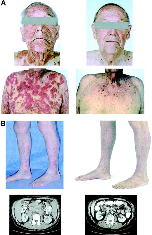 Fig. 2. Clinical effects of depsipeptide. / Photographs of patient 3 (panel A) and photographs and abdominal CT sections of patient 4 (panel B) before (left) and after (right) treatment with depsipeptide. These demonstrate a response of the cutaneous tumors on the face and torso of patient 3 and of the erythematous plaques on the legs, and retroperitoneal lymphadenopathy of patient 4 after treatment with depsipeptide.
