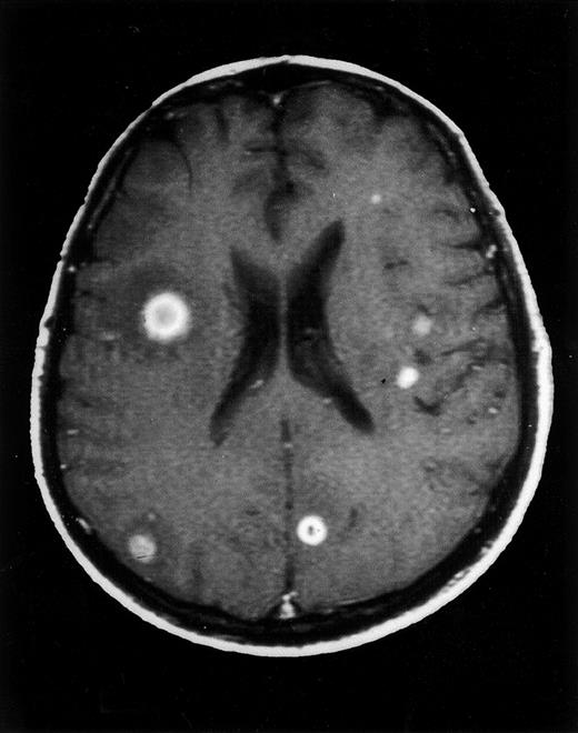 Fig. 1. Axial contrast-enhanced T1-weighted MRI image of the brain at diagnosis. / Multiple intraparenchymal lesions are detected, some with surrounding vasogenic edema. Characteristic ring-enhancing lesions are shown at the right inferior frontal gyrus and the corticomedullary junction of the left superior frontal gyrus.