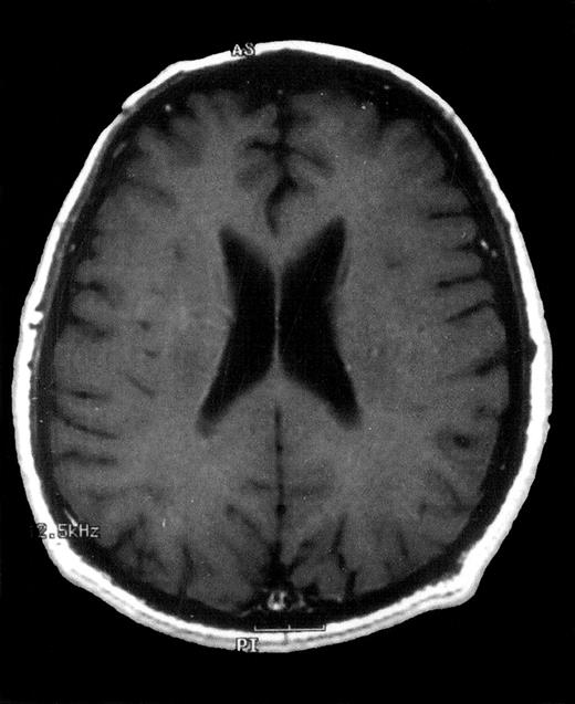 Fig. 2. Axial contrast-enhanced T1-weighted MRI image of the brain 12 months after diagnosis. / Complete disappearance of intracerebral lesions after treatment with oral itraconazole.