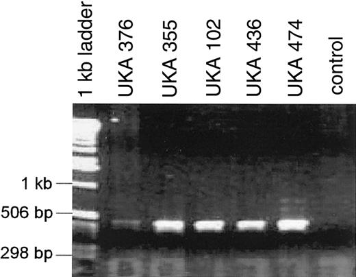Fig. 1. RT-PCR amplification products from factor VIII-VBP1 chimeric mRNA transcripts in 5 severe hemophilia A patients. / Nested primers in factor VIII exon 1 combined with primers in VBP1 exon 2 produced a 500-bp band. The control lane RT-PCR contained normal lymphocyte RNA. Sequence analysis (not shown) revealed factor VIII exon 1 and 2 facultative exons followed by VBP1 exon 2.