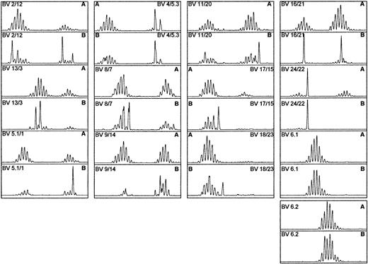 Fig. 2. TCRBV spectratypic profiles from donor 04. / Profiles are for both (A) the unselected preculture PBLs and (B) the postculture CD8+ population of cells. The postculture profile showed a more restricted repertoire, with prominent skewing evident in a number of families.