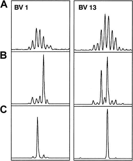 Fig. 5. TCRBV spectratypic profiles from donor 04 for BV1 and BV13. / Profiles are for (A) preculture, (B) postculture CD8+selected, and (C) postculture HCMV pp65–specific HLA-A*0201 tetrameric complex–selected cells. Examples are shown of populations that were expanded after the culture that were selected based on tetramer-guided sorting (BV13—the larger of the 2 major size classes in panel B) along with those that were not selected (BV1 and BV13). In addition, the size class selected in panel C for BV1 showed no correspondingly expanded size class peak in the CD8+ selected population.