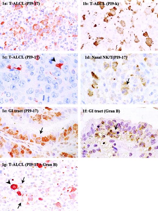 Fig. 1. Immunohistochemical detection of PI9 in nodal and extranodal T-cell NHLs. / Tissue sections of T-ALCL (A-C,G), NK/T-cell, nasal type (D), and enteropathy-type T-cell NHL (E,F) were stained with mAb PI9-17 (A,C-E), mAb PI9-K (B), or antigranzyme B mAb GB7 (F). The section in panel G was double-stained with mAb PI9-17 (red) and GB7 (brown). The arrowhead in panel C denotes an example of a PI9+ dendritic cell. The arrows in panels D to F point to tumor cells positive for PI9 (D,E) and granzyme B (F). In panel G the arrows point to tumor-infiltrating CTLs positive for granzyme B and the arrowhead denotes an example of a PI9+ neoplastic cell. Original magnification × 630.
