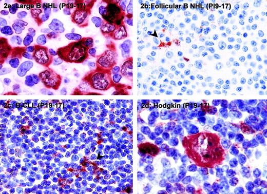 Fig. 2. PI9 is expressed in high-grade B-cell NHLs and some cases of Hodgkin lymphoma. / The following tumors were stained for PI9: diffuse large B-cell lymphoma (A), follicular B-cell NHL (B), B-CLL (C), and classical Hodgkin disease, nodular sclerosing subtype (D). Tissue sections were stained with mAb PI9-17 as described in “Patients, materials, and methods” and counterstained with hematoxylin. The arrowheads in panels B and C denote PI9+ dendritic cells, which served as a positive internal control for staining. Original magnification × 1000 for panels A and D; × 400 for panels B and C.