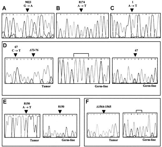 Fig. 1. ATM sequencing analysis of REF-positive MCL. / Arrows point to nucleotide positions affected by mutations. (A) Missense mutation in sample 2, resulting in R3008H. (B) Missense mutation in sample 6, resulting in D2725V. (C) Substitution of the first methionine in sample 7, resulting in M1L. (D) Nonsense mutation (R23stop) and a downstream 4-bp deletion in sample 8 (left). Germline DNA sequencing of the same patient showing the absence of the deletion (center) and the presence of the R23stop mutation in heterozygosity (right). Brackets span over the deleted nucleotides. (E) Heterozygous missense mutation resulting in K2717M in sample 12 (left). The germline DNA of the same patient (right) shows a normal sequence demonstrating the somatic acquired origin of this mutation in the tumor. (F) Sample 13 showing a 2-bp deletion resulting in FS564stop with no evidence of the normal allele (left). Germline DNA sequencing of the same patient (right), demonstrating the somatic acquired origin of this deletion in the tumor sample. Brackets span the deleted nucleotides.