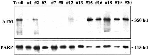 Fig. 2. ATM protein expression analysis in MCL. / Relatively high levels of ATM protein expression were detected in samples 15, 16, 18, 19, and 20, similar to those observed in normal tonsil. Partial loss (samples 2, 12) or complete absence (samples 1, 3, 7, 8, 13) of protein expression was detected in several tumors. Expression of PARP in the same samples used as a loading control is shown in the lower panel.