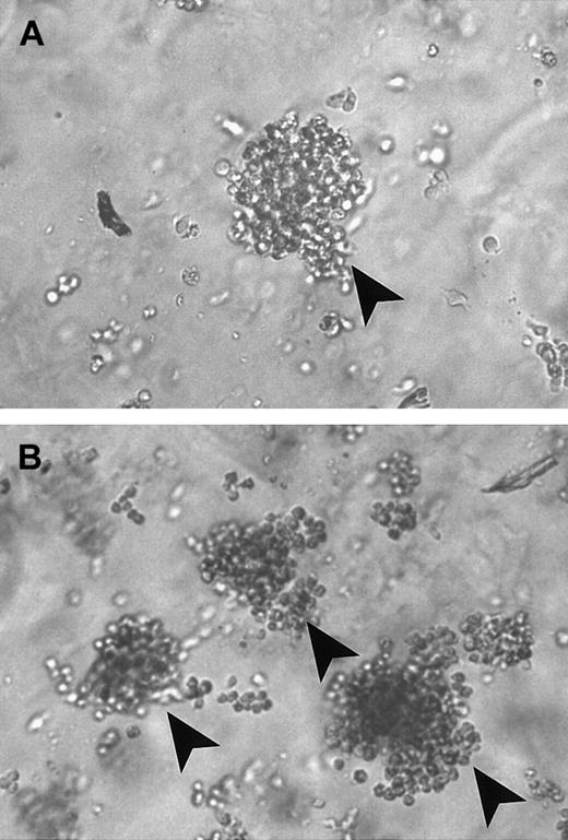 Fig. 1. T-cell colonies of representative case of PNH. / (A) In the presence of 6-TG. (B) In the absence of 6-TG. Arrows indicate individual colonies.