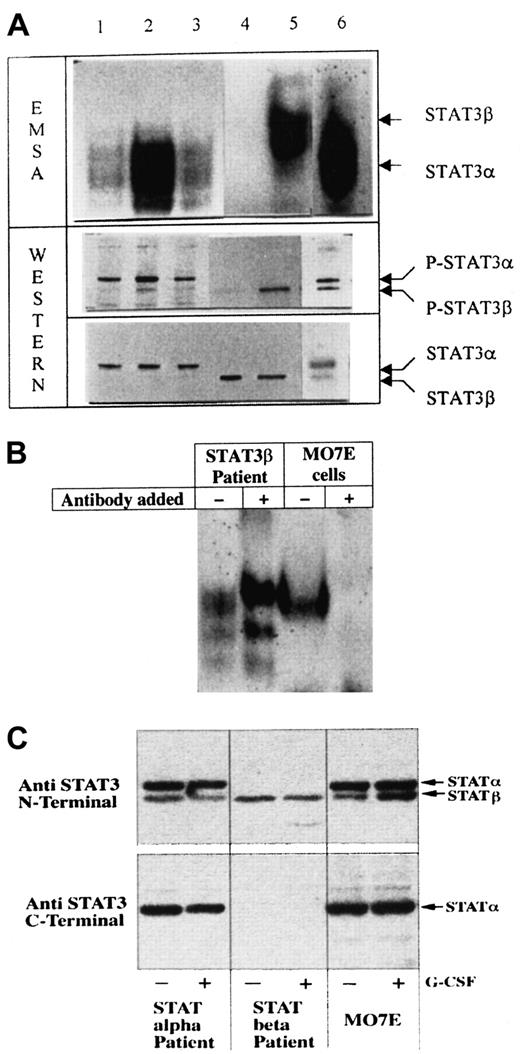 Fig. 1. Constitutive STAT3 activity in AML blasts. / (A) The top panel shows EMSA, demonstrating the SIE-binding activity of STAT3, and the lower 2 panels show Western blotting. The middle panel shows hybridization with antibodies against phosphorylated STAT3, and the lower panel shows hybridization with anti-STAT3 antibodies to demonstrate equal loading. The positions of STAT3α and STAT3β are indicated. Lanes 1, 2, 3, 5, and 6 show patient samples with constitutive STAT3 activity. Lane 4 represents a patient sample without constitutive STAT3 activity. Note that the bands in lanes 1, 2, 3, and 6 demonstrate faster migration—that is, STAT3α—whereas the band in lane 5 shows slower migration—that is, STAT3β. (B) Supershift analysis of the SIE band complex formed with C-terminally directed anti-STAT3 antibodies in cells from a patient expressing predominantly STAT3β and MO7E cells expressing predominantly STAT3α. There is no supershift in the patient sample, whereas STAT3α is supershifted in MO7E cells. (C) Western blot analysis of STAT3 hybridized with antibodies directed against the N-terminal (top panel) and the C-terminal (lower panel) domains. When using antibodies directed against the C-terminal domain of STAT3, STAT3β was not detected. To verify that no change occurred after cytokine exposure, samples were exposed to human G-CSF (10 ng/mL) for 10 minutes as previously described.13