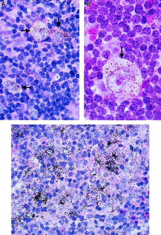 Fig. 1. TIMP-1 expression (ISH analysis) in sections of lymph nodes from patients with HD. / Positive cells are characterized by an accumulation of black or brown stains (arrows). (A,B) TIMP-1 expression in H/R-S cells, and TIMP-1 expression in reactive lymphoid tissue. (C) TIMP-1 expression in areas of tissue remodeling.