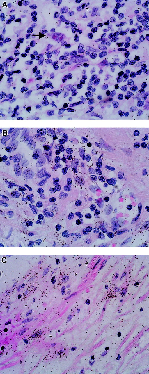Fig. 3. TIMP-2 expression (ISH analysis) in sections of lymph nodes from patients with HD. / Positive cells are characterized by an accumulation of black stains. (A) TIMP-2–negative H/R-S cells (arrow). (B) TIMP-2 expression in reactive lymphoid tissue. (C) TIMP-2 expression in fibrotic areas.