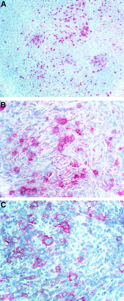 Fig. 4. Immunostaining of TIMP-1 protein. / Specific anti–TIMP-1 antibody (A,B) and CD30 antibody (C) were used on acetone-fixed, frozen lymph node sections from patients with HD.