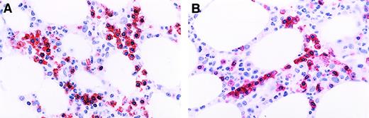Fig. 1. Patterns of staining for CD8 in T-cell GLL. / (A) Immunoperoxidase stain for CD8 demonstrating distinct membrane staining in confluent aggregates of more than 8 CD8+ lymphocytes. Aminoethyl carbazol chromogen, hematoxylin counterstain; original magnification: × 150. (B) Immunoperoxidase stain CD8 demonstrating a linear array of CD8+ intravascular T cells. Aminoethyl carbazol chromogen, hematoxylin counterstain; original magnification: × 240.