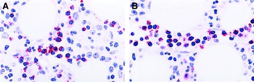 Fig. 2. Patterns of staining for granzyme B in T-cell GLL. / (A) Immunoperoxidase stain for granzyme B demonstrating an interstitial cluster of more than 6 granzyme B+ T cells. Aminoethyl carbazol chromogen, hematoxylin counterstain; original magnification: × 240. (B) Immunoperoxidase stain for granzyme B demonstrating the intravascular location of the granzyme B+ lymphocytes. Aminoethyl carbazol chromogen, hematoxylin counterstain; original magnification: × 240.