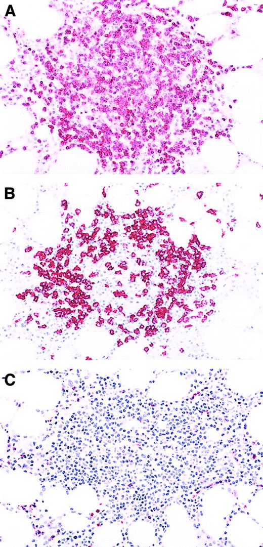 Fig. 3. Aggregate of nonneoplastic lymphocytes in a bone marrow specimen involved by T-cell GLL. / (A) Immunoperoxidase stain for CD3. Most of the lymphocytes in the aggregate are CD3+ T cells. Aminoethyl carbazol chromogen, hematoxylin counterstain; original magnification: × 80. (B) Immunoperoxidase stain for CD20. The lymphoid aggregate contains few CD20+ B cells. Aminoethyl carbazol chromogen, hematoxylin counterstain; original magnification: × 80. (C) Immunoperoxidase stain for granzyme B. Virtually none of the neoplastic granzyme B+ granular lymphocytes are present in the lymphoid aggregate, but they can be seen in the bone marrow interstitium and the blood vessels at the periphery of the aggregate. Aminoethyl carbazol chromogen, hematoxylin counterstain; original magnification: × 80.