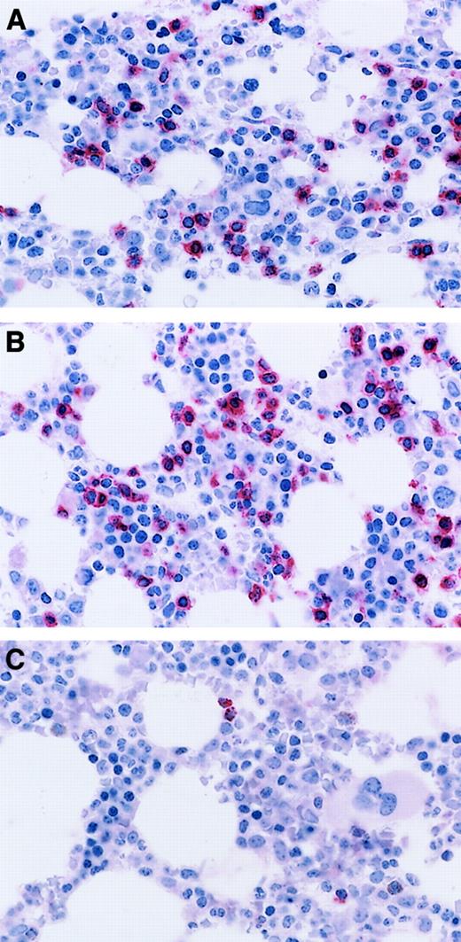 Fig. 4. CTL immunostaining in nonclonal T-cell LGL disorder. / Immunoperoxidase stains for CD3 (A) and CD8 (B) demonstrating increased numbers of singly distributed cells in the marrow interstitium. Aminoethyl carbazol chromogen, hematoxylin counterstain; original magnification: × 240. (C) Immunoperoxidase stain for granzyme B demonstrating isolated positive cells. Aminoethyl carbazol chromogen, hematoxylin counterstain; original magnification: × 240.