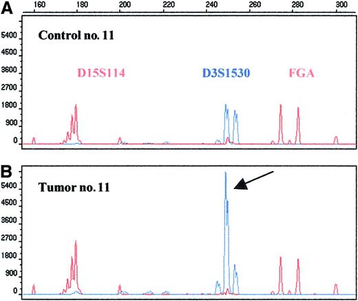 Fig. 2. High-level amplification in the 3q26.2-27 region as detected by microsatellite D3S1530. / Repeats D3S1530, D15S114, and FGA were amplified in a multiplex PCR; the last 2 markers were used as an internal control. The 250–base pair allele of the D3S1530 shows 3.5-fold amplification (arrow).