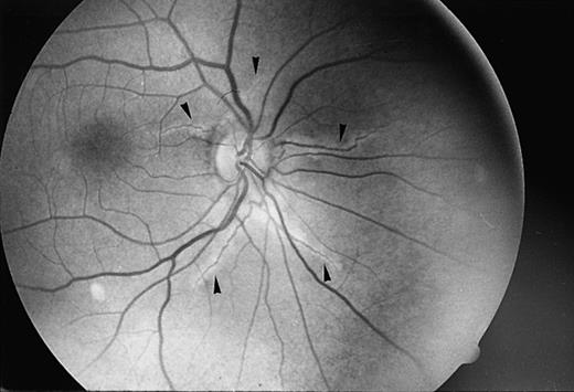 Fig. 1. Angioid streaks (arrows) in a patient with β thalassemia (Dr Aessopos' collection). / Magnification, ×8.5.