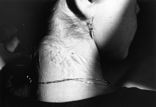 Fig. 2. Typical cutaneous manifestations of PXE on the dorsal aspect of the cervical area in a β thalassemic case (Dr Aessopos' collection).