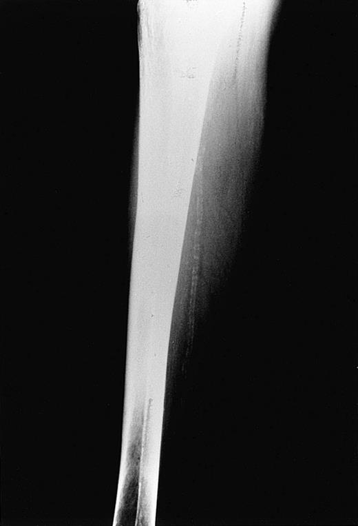 Fig. 3. Tibial artery calcification in a 58-year-old patient with β thalassemia (Dr Aessopos' collection).