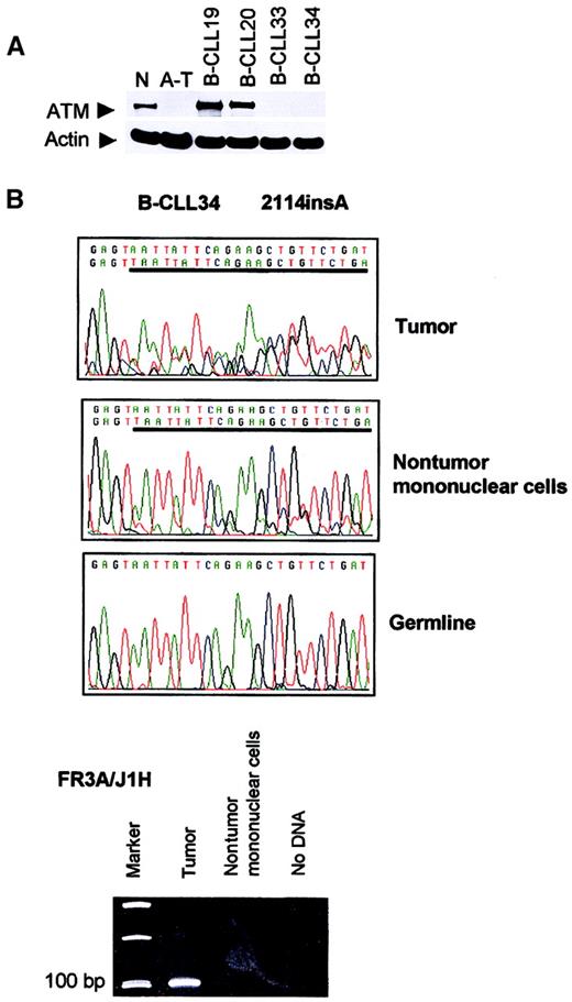Fig. 1. Absence of ATM in B-CLLs 33 and 34 and presence of. / ATM mutation 2114insA in B-CLL 34 nontumor mononuclear cells. (A) Western blot showing complete loss of ATM in B-CLL tumors 33 and 34. N indicates normal lymphoblastoid cell line (LCL); A-T, LCL derived from an ataxia telangiectasia patient with 2 nullATM alleles; B-CLL 19 and 20, 2 tumors withoutATM mutations; B-CLL 33 and 34, tumors with 2 ATMmutations (or LOH). (B) Truncating mutation 2114insA (given as reverse sequence) in patient B-CLL 34 was present in DNA from both tumor (CD19+) and nontumor (CD19−) compartment, but not present in the buccal smear DNA. An immune system gene rearrangement could be detected only from the tumor population of patient B-CLL 34, but not from the nontumor cells, suggesting the absence of cross contamination between nontumor and tumor cells.