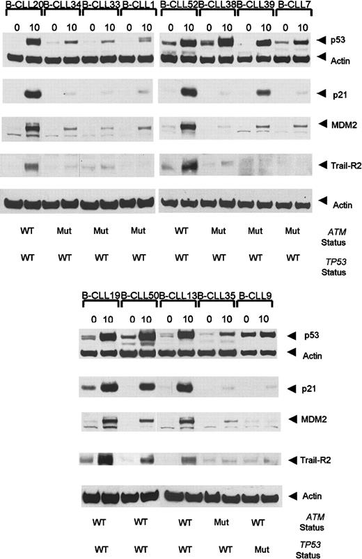 Fig. 3. Ionizing radiation-induced accumulation of p53, p21, MDM2, and TRAIL-R2 at 0 hours and 10 hours following IR in. / ATM mutant B-CLLs. B-CLLs 34, 33, 7, 1, and 35 are representative of 8 tumors with ATM mutations showing defective p53, p21, and MDM2 responses following exposure to IR. B-CLLs 38 and 39 are ATM mutant tumors with normal p53 accumulation but defective p21 and MDM2 up-regulation. A B-CLL tumor (B-CLL 9) withTP53 mutation showed an elevated basal p53 protein level but a defect in the ability to accumulate p53 and up-regulate p21 and MDM2. B-CLLs 20, 52, 19, 50, and 13 are representative of 19 analyzed tumors with wild-type ATM and p53 which showed normal p53, p21, and MDM2 responses. The TRAIL-R2 response 10 hours after irradiation was defective in ATM-deficient tumors (B-CLLs 34, 33, 1, 38, 39, 7, and 35) as well as in TP53 mutant (Mut) B-CLL 9, but it was normal in B-CLLs 20, 52, 19, 50, and 13 representative of 12 B-CLLs withATM/TP53 wild type (WT) analyzed for TRAIL-R2 response. The actin expression shows equal loading.