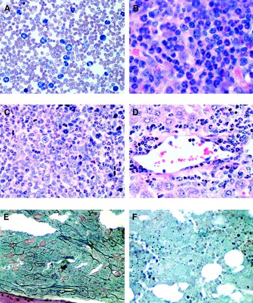 Fig. 4. Histopathology of mice receiving transplants of FLT3-ITD–transduced bone marrow. / (A) Peripheral blood smear (Wright-Giemsa stain, original magnification × 400) from a representative FLT3-ITD mouse (mouse 51.1) reveals marked leukocytosis comprised predominantly of maturing myeloid elements. (B) Bone marrow from the femur of the same mouse (hematoxylin and eosin, original magnification × 500) reveals features of a myeloproliferative disorder with marked hypercellularity and myeloid hyperplasia consisting predominantly of mature granulocytic elements. Spleen (C) and liver (D) (hematoxylin and eosin, original magnification, × 500) also reveal an identical myeloid infiltrate in the Flt3-ITD mouse (mouse 51.1). (E) Bone marrow of a Flt3-ITD mouse (mouse 78.5) and (F) bone marrow from a wild-type FLT3 mouse. Both were stained to highlight reticulin fibers (black) (original magnification, × 500). There is a marked increase in reticulin fibrosis in the FLT3-ITD mice compared to wild-type FLT3 mice.
