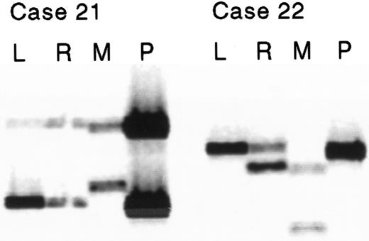Fig. 1. Two examples showing loss of the maternally inherited allele at marker D9S746. / The lanes show leukemic (L), remission (R), maternal (M), and paternal (P) microsatellite PCR products as imaged on a LI-COR DNA sequencer.