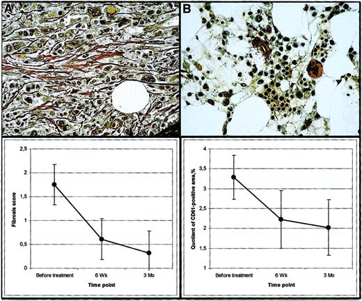 Fig. 1. Effects of STI571 treatment on bone marrow fibrosis and megakaryocytes. / (A) Group 3 patient FM. Bone marrow biopsy before STI571 treatment showing marked fibrosis (grade 3). Gomori stain, × 400. (B) Same patient. Bone marrow biopsy after 3-month STI571 treatment without fibrosis (grade 0). Gomori stain, × 400. (C) Estimated dynamics of bone marrow fibrosis during therapy. 0 corresponds to absence of fibrosis. Error bars represent 95% confidence intervals. Estimates were obtained from a multivariate model and are bootstrap-corrected and adjusted for patient grouping. (D) Estimated dynamics of CD61+ megakaryocytes during therapy. Error bars represent 95% confidence intervals. Estimates were obtained from a multivariate model and are bootstrap-corrected and adjusted for patient grouping.