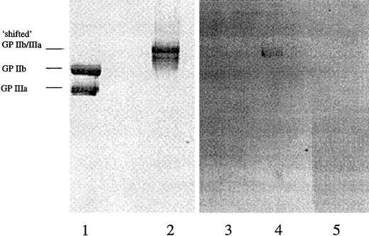 Fig. 5. DDABs detect neoepitopes in conformational altered GP IIb/IIIa. / Purified GP IIb/IIIa was fractionated by SDS-PAGE without (lanes 1 and 3) or after preincubation with XP280 (lanes 2, 4, and 5). Lanes 1 and 2 were analyzed by protein stain, lanes 3 and 4 by immunoblotting using patient 307 peak titer PPP, and lane 5 by immunoblotting using patient 307 predose PPP. The mobilities of the “shifted” GP IIb/IIIa and the GP IIb and IIIa subunits are indicated.