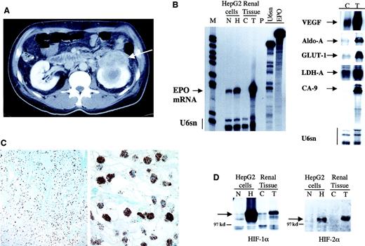 Fig. 1. RCC with molecular characteristics that resulted in pronounced polycythemia. / Computed tomography of the abdomen showing a left-sided renal mass (arrow) with central necrosis (A). Ribonuclease protection assay for EPO transcripts (B, left panel) and other hypoxia-inducible genes (B, right panel) demonstrated markedly elevated expression of these genes in the tumor (T) as compared with the control (C) adjacent nontumorous kidney tissue. Cell extracts from HepG2 cells were exposed to normoxia (N) or 16 hours of hypoxia (H) for comparison. U6sn served as internal control. Radiolabelled probes were protected from ribonuclease digestion by hybridization to 50 μg or 1 μg total RNA for HIF targets and U6sn, respectively. M indicates molecular weight marker; P, digested riboprobes; and U6sn and EPO, undigested riboprobes. Immunohistochemistry for HIF-1α of the tumor tissue shows homogenous nuclear staining of virtually every tumor cell (C). Sections were counterstained with Richardson's reagent. Magnifications are 100 × and 800 ×, respectively. Immunoblotting of protein extracts from tumor (T), control kidney tissue (C), and HepG2 cell extracts under normoxia (N) and 4 hours of hypoxia (H) demonstrates pronounced up-regulation of HIF-1α and HIF-2α proteins (arrows in panel D). The position of the 97 kd marker is indicated.