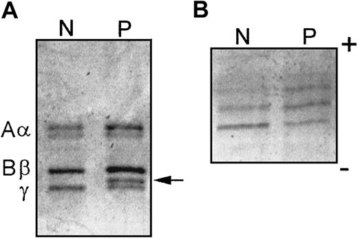 Fig. 1. SDS-PAGE and IEF demonstrate an abnormal chain in fibrinogen Hillsborough. / (A) SDS-PAGE of normal (N) and propositus (P) fibrinogens under reduced conditions. The normal Aα, Bβ, and γ chains are labeled on the left and the abnormal γ chain is indicated on the right (arrow). (B) IEF of purified γ chains over the pH range of 4 to 8.