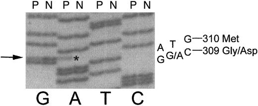 Fig. 2. DNA sequence of exon 8 of the fibrinogen γ chain reveals a heterozygous mutation in the propositus (P) as compared to normal (N). / The propositus is heterozygous for a GGC→ GA*C mutation, indicated by arrow on left, which causes a Gly→ Asp amino acid change at residue γ309.