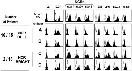 Fig. 1. Phenotypic analysis of NK cells from patients with acute leukemia shows abnormal NCRdull expression. / NK cells were cultured as described in “Materials and methods” and then analyzed by flow cytometry for expression of the indicated molecules. Blank areas correspond to isotype-matched negative controls. The first row corresponds to the analysis of NK cells from a representative healthy donor, whereas the 4 other rows show the phenotype of NK cells obtained from patients with AML (NK-AML cells) at diagnosis (before chemotherapy). All phenotypes were controlled at least 3 times during the culture period (from 2 to 7 weeks), and no major changes in NK phenotypes were observed. The 4 examples of NK-AML are representative of the 18 patients analyzed.