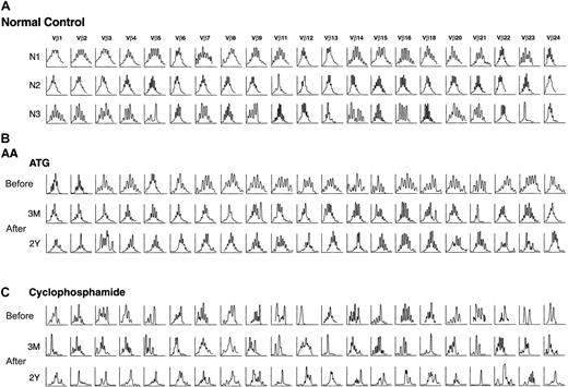 Fig. 1. VB skewing in healthy controls and patients with aplastic anemia. / In patients with AA, CDR3 size distribution patterns were compared before and after immunosuppressive therapy. ATG indicates antithymocyte globulin. Fluorescence intensity versus molecular weight.