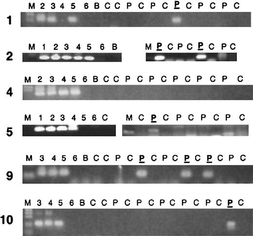 Fig. 1. PCR analysis of clonotypic genomic AML1-ETOfusions in neonatal Guthrie cards of leukemic patients. / Two rounds of PCR (70 total cycles) were performed as described in “Patients, materials, and methods,” and the results are shown only from the secondary round. Partial results are shown; in most cases a second PCR run was performed. Five “positive” PCR patients are shown, as well as one negative. Lane markers: M indicates marker. Lanes 1-6 show 1:10 dilutions of patient DNA, with lane 1 being 100 ng/μL and lane 6, 1 pg/μL DNA. Patient DNAs have varying percentages of leukemic DNA, as some patient samples are from blood rather than bone marrow. C indicates control Guthrie card without patient DNA; P, Guthrie card segment from the patient; P, patient Guthrie card segment that was sequenced and determined to be the same sequence as the diagnostic DNA sample of that patient; B, no DNA sample (blank).