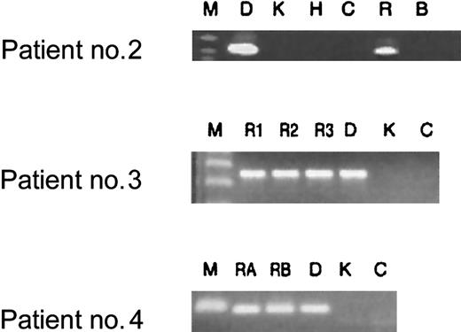 Fig. 2. Analysis of patient remission DNA for clonotypicAML1-ETO translocation persistence after treatment. / First, DNA extracted from bone marrow samples was tested for integrity with the use of control gene PCRs (NQO1 and NRASprimers, data not shown). With the same primer sets that were used for screening Guthrie cards, bone marrow samples obtained from treated patients were tested for translocation sequences. All patient samples tested after treatment proved to be positive for clonotypic fusion sequence after 2 rounds of PCR (lanes R). Key to lanes: M indicates marker; D, diagnostic patient–specific DNA; K, Kasumi cell line DNA; H, HL-60 cell line DNA; C, human DNA from a nonpatient control; R, bone marrow sample for patient no. 2 obtained while the patient was on treatment at 5 months after diagnosis; R1, R2, and R3, bone marrow samples from patient no. 3 obtained immediately following induction treatment (2 months after diagnosis), at the end of consolidation (3 months after diagnosis), and 4 months off all therapy (8 months after diagnosis), respectively; RA and RB, DNA from bone marrow from patient no. 4 obtained when the patient was just off all therapy (11 months after diagnosis) and 6 months off all therapy (16 months after diagnosis), respectively.