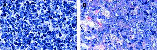 Fig. 1. Cytomorphologic features of FL 3. / (A) FL 3a. Neoplastic infiltrate is composed of large noncleaved cells (centroblasts) and small to medium-sized, sometimes large, cleaved cells (centrocytes). (B) FL 3b. A population of small and large noncleaved cells (centroblasts) is seen, without an admixture of centrocytes. Original magnification, × 800. Stained with Giemsa.